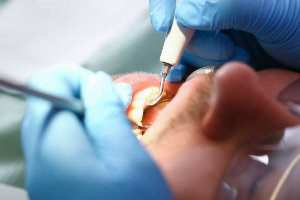 Best Emergency Treatment for Toothache in Fairwood, WA